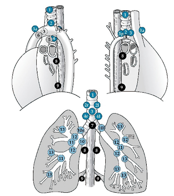 cT1N0期浸润性NSCLC 纵隔淋巴结转移模式可被预测